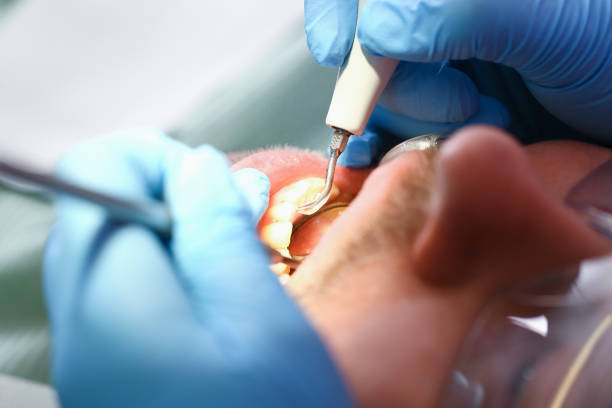 Best Dentist for Tooth Abscess  in Anna, OH